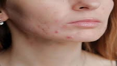 Cost of laser acne treatment in Dubai,