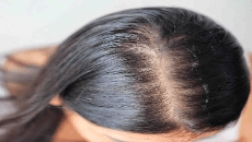 Find The Best Hair Loss Treatment Clinic In Noida At Alopecia Herbal Treatment