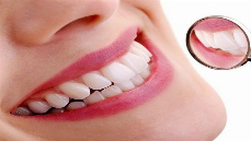 Hollywood Smile Design in Dubai