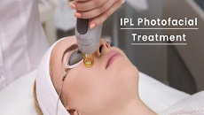 IPL Photofacial Treatment / IVA Skin & Laser Center