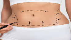 Liposuction in Dubai  Lipo Clinic