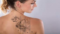 Painless Laser Tattoo Removal in Dubai