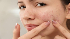 Pimples Treatment in Dubai